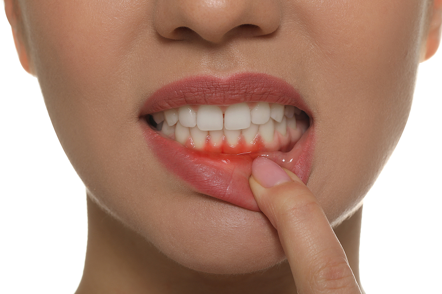 Gum Disease: Causes, Signs & Risks