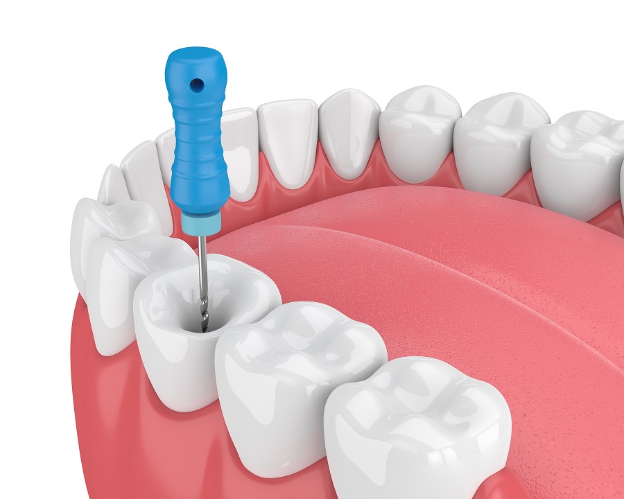 What Exactly Is a Root Canal?